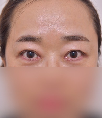 상안검+눈매교정+눈밑지방제거+눈밑지방재배…