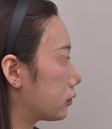 무보형물 코성형