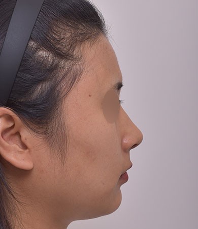 무보형코성형+매부리교정