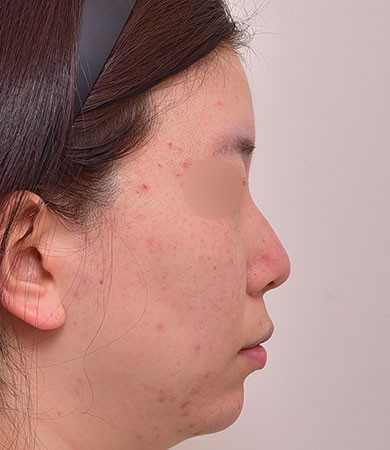 무보형 코성형 + 매부리교정