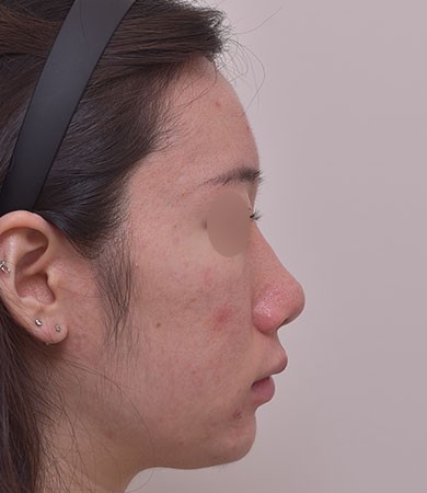 무보형물 코성형