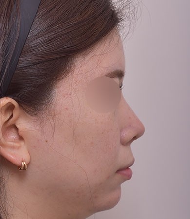 무보형 코성형 + 매부리교정