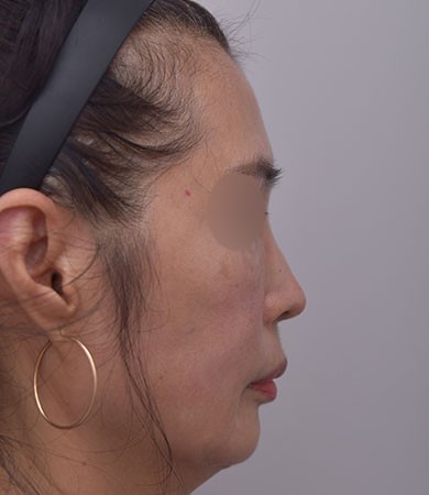 무보형물코성형