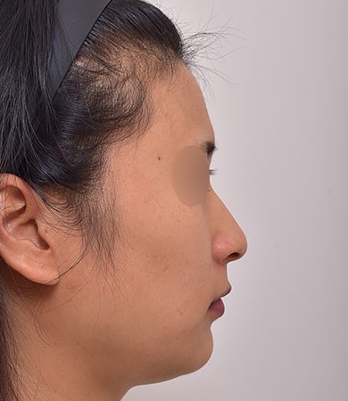 무보형코성형+매부리교정