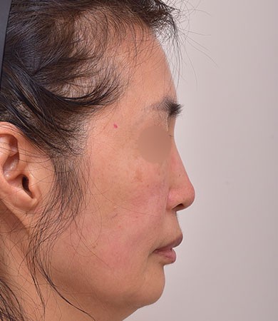 무보형물코성형