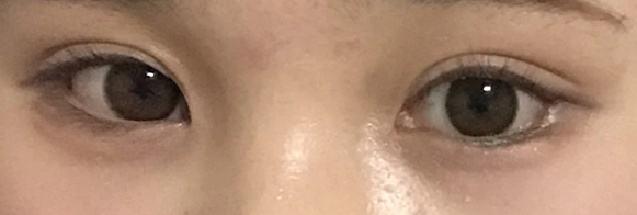다이아트임 전후사진