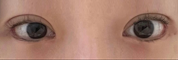 다이아트임 전후사진