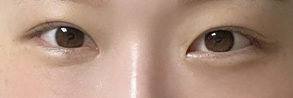 눈밑지방재배치 전후사진