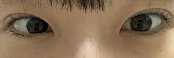 눈밑지방재배치 전후사진