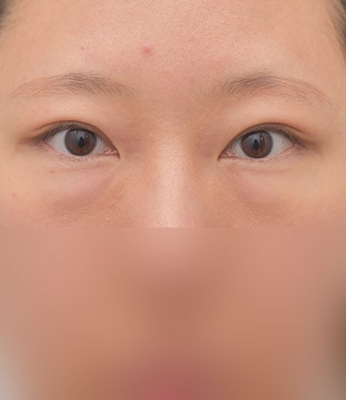 눈밑지방재배치