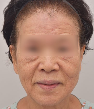 안면거상