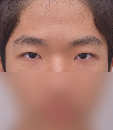 눈성형(자연유착)+눈매교정+앞트임