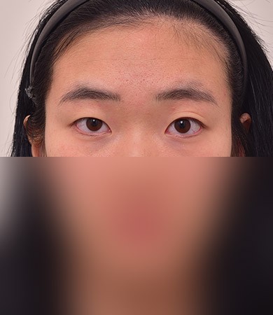 눈성형 + 눈매교정 + 앞트임